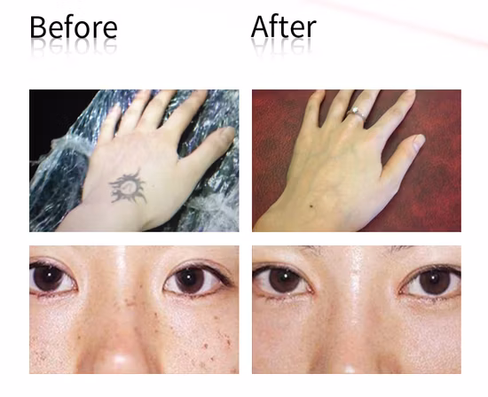 Handheld Pico Laser Blau Rot Laser Pikosekundenstift zur Tattooentfernung